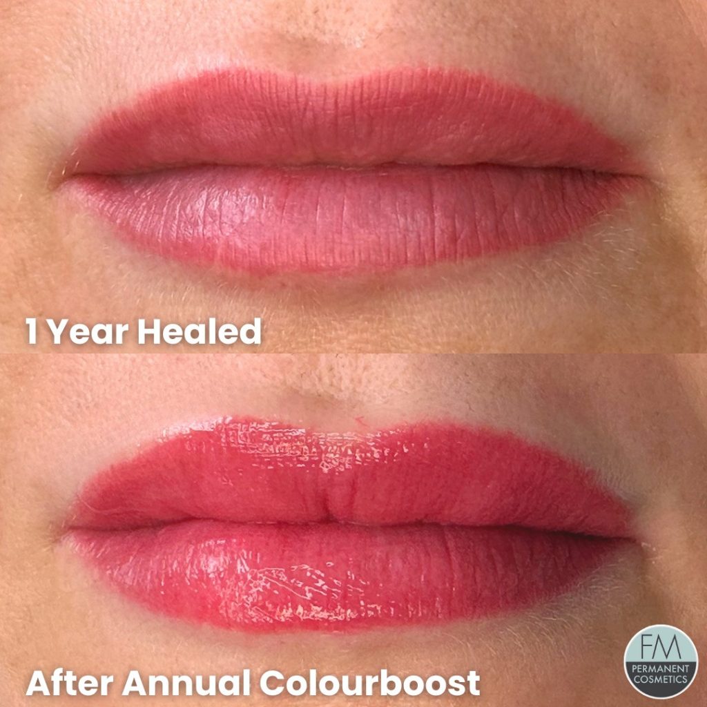 full lips healed after 1 year and after annual colourboost