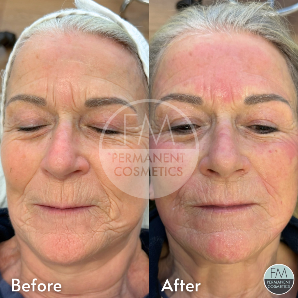 before and after facial