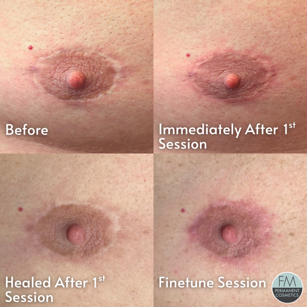 areola before, immediately after, healed, and finetuned